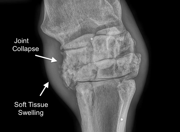 Severe Carpal Arthritis 