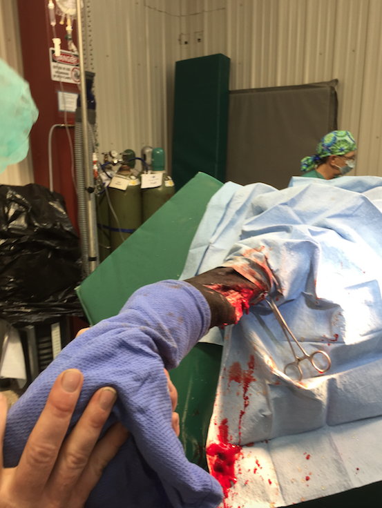 Severe Flexor Tendon Wound Prior to Repair & Casting